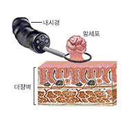 용종 절제술 1