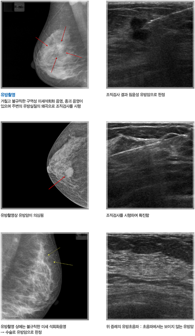 여러가지 유방암 증례 사진